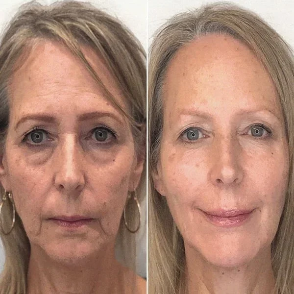 Last Day Promotion 49% OFF - đ„Botox Face Serum