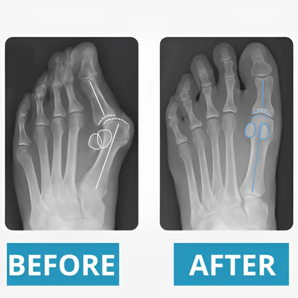 Bunion Corrective Toe Socks