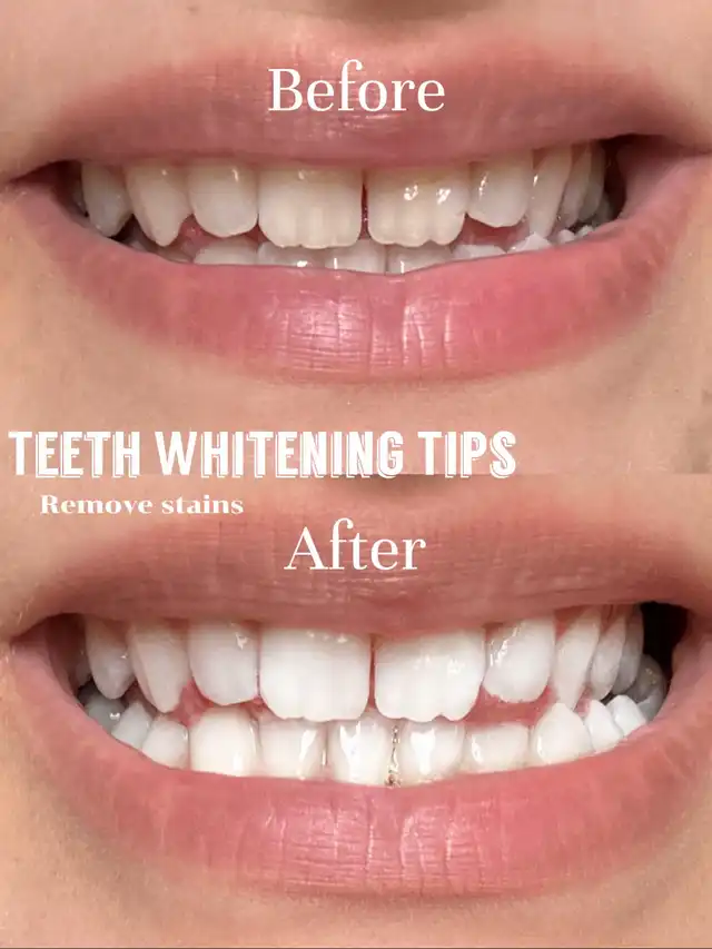 Teeth Whitening Powder| Instant Whitening and Stain Removal