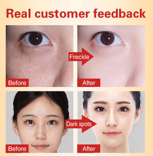 Whitening Anti-Freckle Moisturizing Cream
