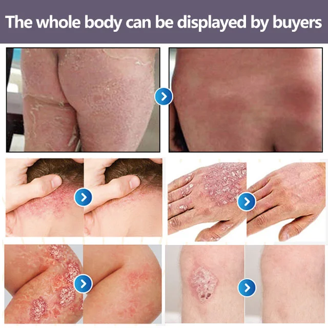 Psoriasis Treatment Cream Moss Repair Itchy Skin Relief