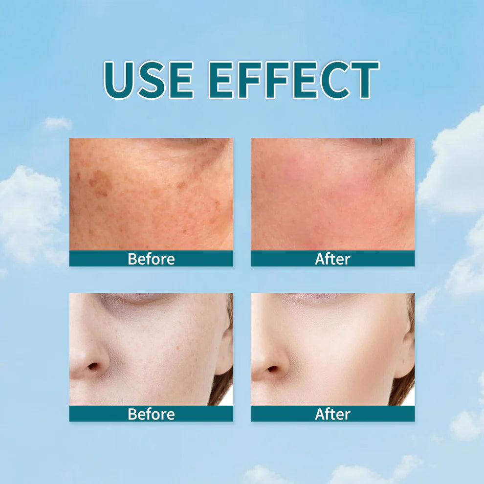 Facial Freckle Spot Serum💥BUY 1 GET 1 FREE💥