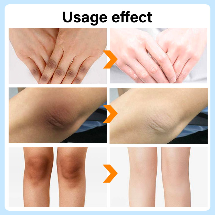 Whitening and lightening joint melanin and whitening cream