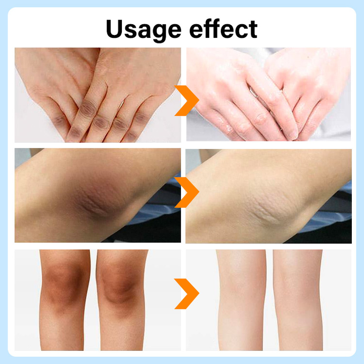 Whitening and lightening joint melanin and whitening cream
