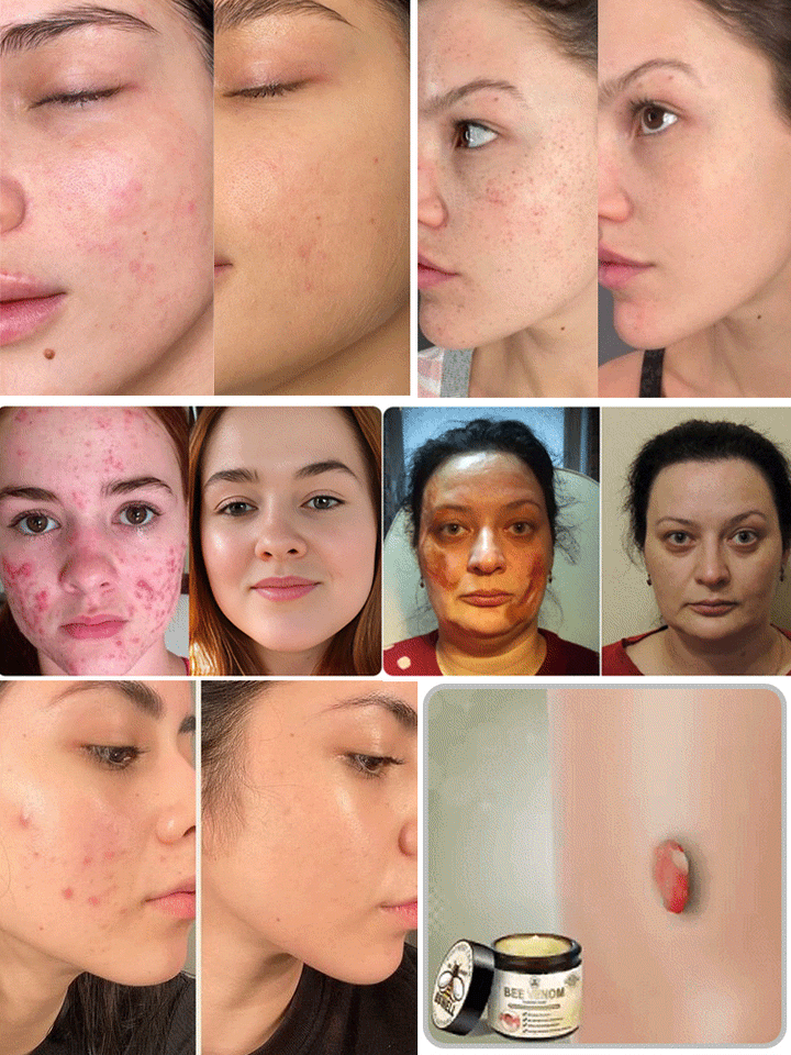Skin moss nevus and granular skin repair cream