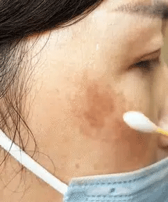 Freckle-Banishing Serum for Face
