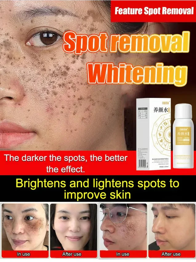 【ALL KINDS OF SPOTS CAN BE REMOVED WITH ONE SPRAY】BLEMISH REMOVAL, WHITENING AND BEAUTY WATER