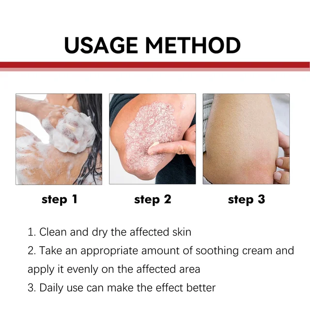 Psoriasis Treatment Cream Moss Repair Itchy Skin Relief