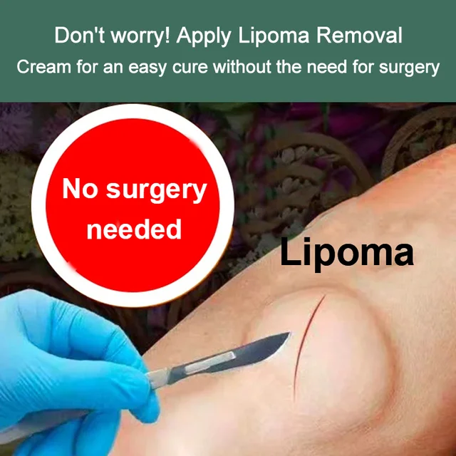 Lipoma Removal Cream