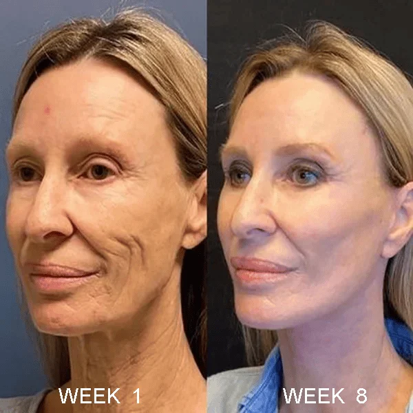 🔥Last Day Promotion 49% OFF 🔥Botox Anti-Aging Serum