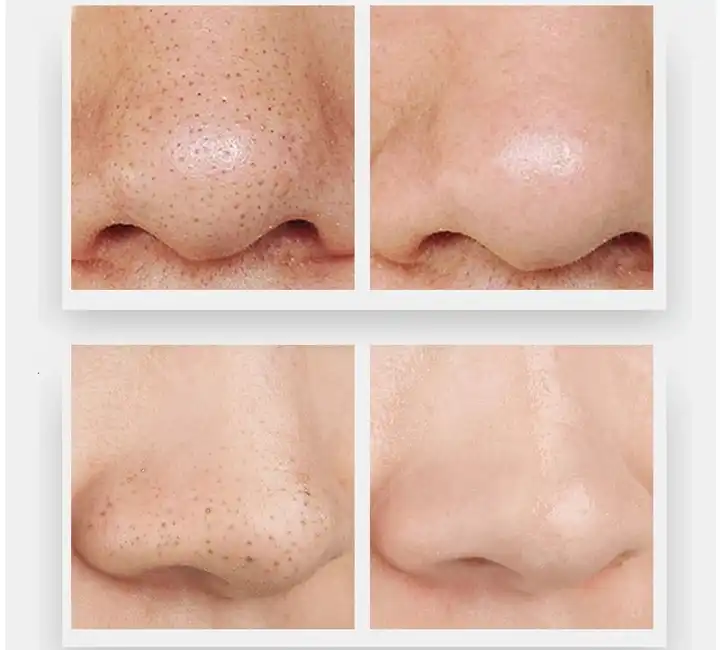 Blackhead Removing Facial Mask