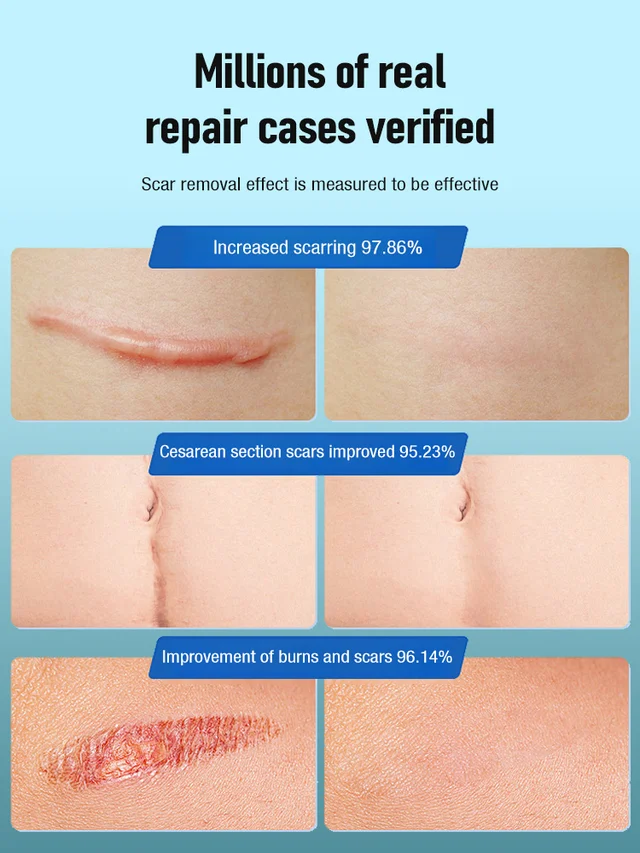 Advanced Scar Removal Spray