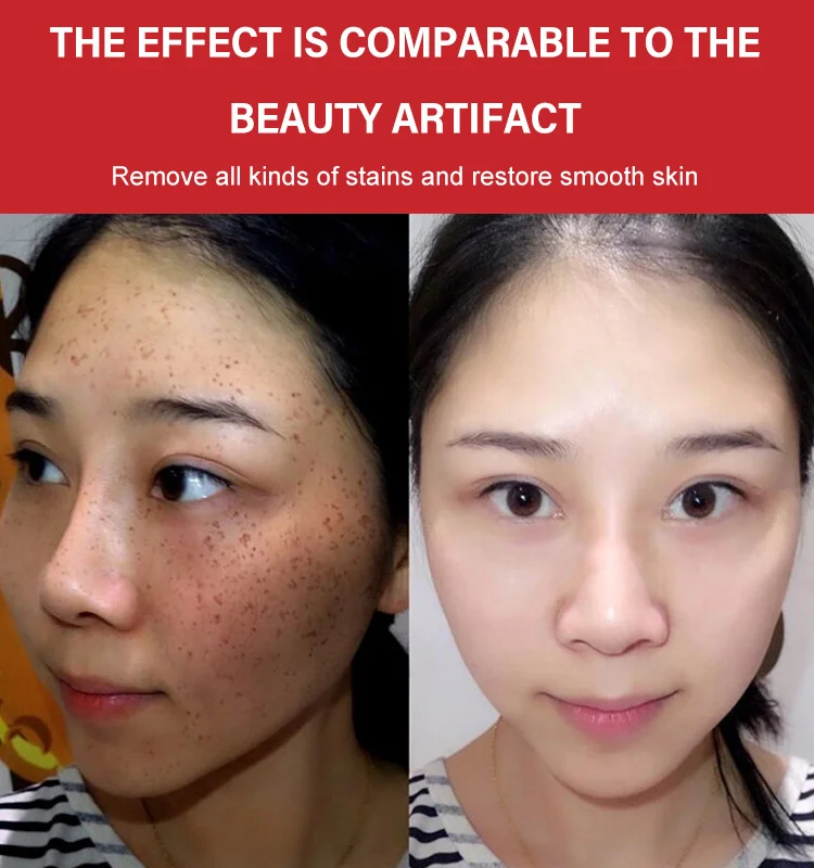 BRIGHTENING FRECKLE CREAM
