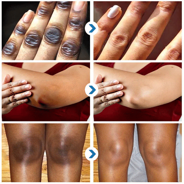 Armpit Melanin Removal Whitening Cream