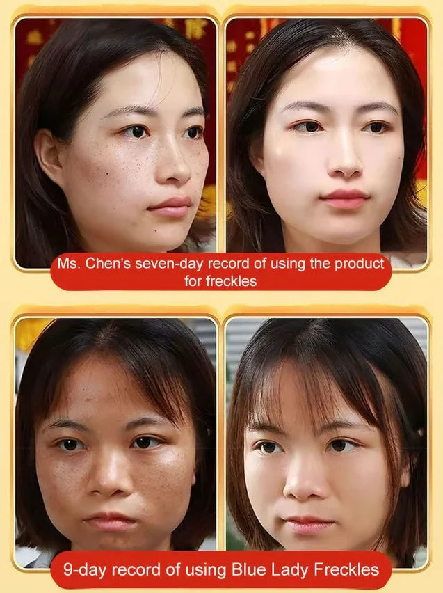 【ALL KINDS OF SPOTS CAN BE REMOVED WITH ONE SPRAY】BLEMISH REMOVAL, WHITENING AND BEAUTY WATER