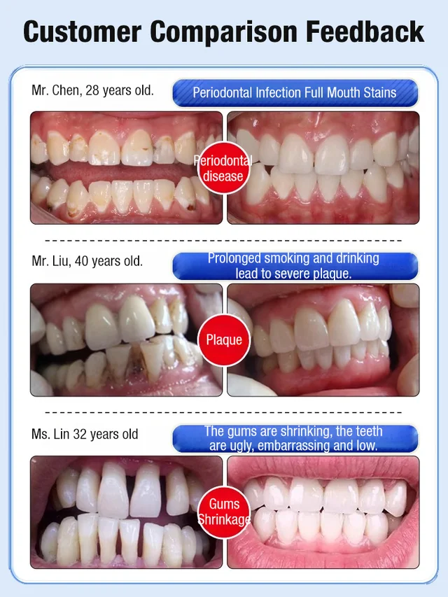 Dental separators