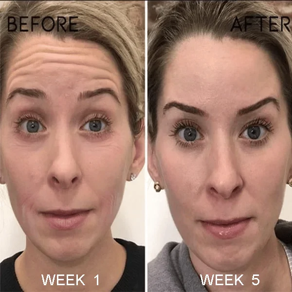 🔥Last Day Promotion 49% OFF 🔥Botox Anti-Aging Serum