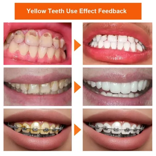 Probiotic whitening and yellowing teeth cleaning powder