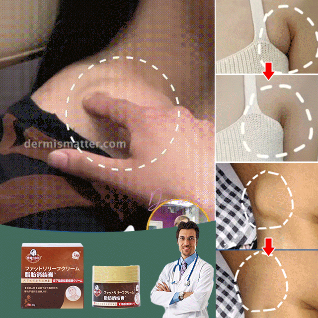 Lipoma Removal Cream