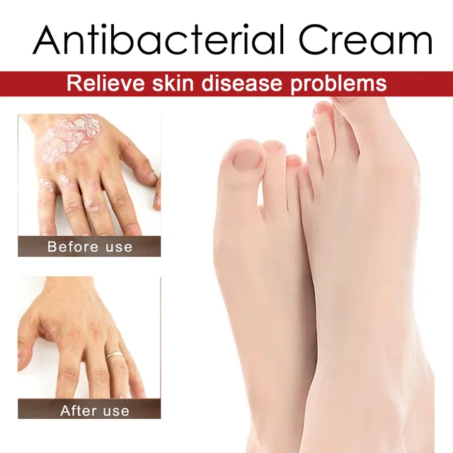 Psoriasis Treatment Cream Moss Repair Itchy Skin Relief