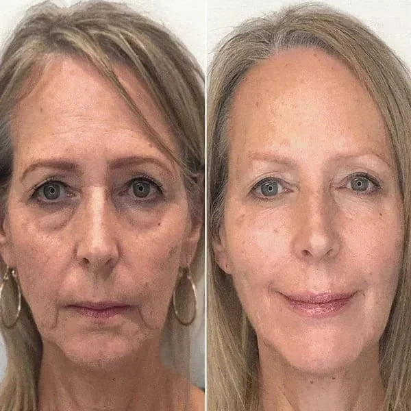 LAST DAY PROMOTION 49% OFF - 🔥BOTOX FACE SERUM