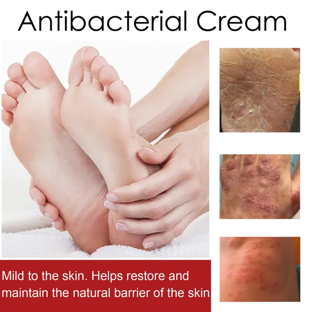 Psoriasis Treatment Cream Moss Repair Itchy Skin Relief