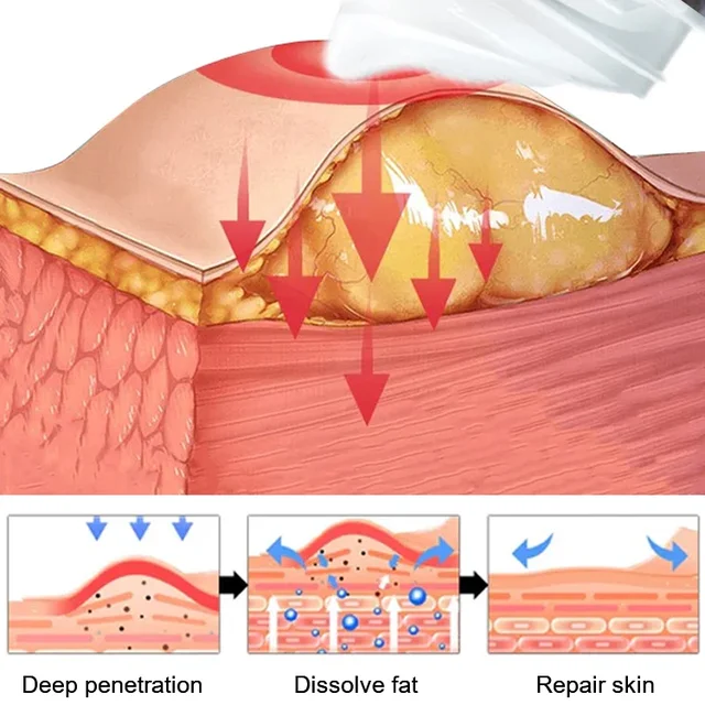 Lipoma Removal Cream