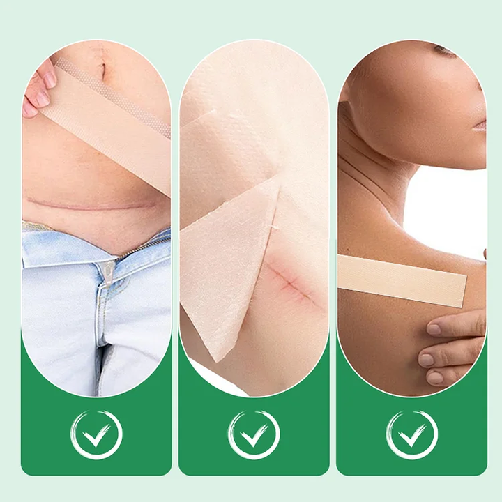 Reusable Silicone Scar Sheets for Surgical Scars