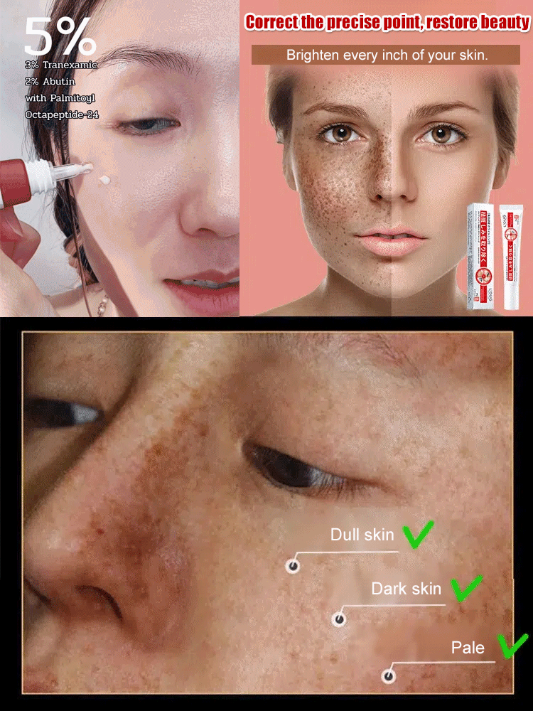 Whitening and spot cream