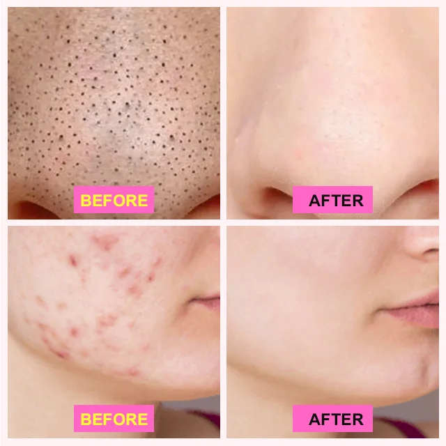 Mineral Mud Blackhead Removal Nose Pore Strips