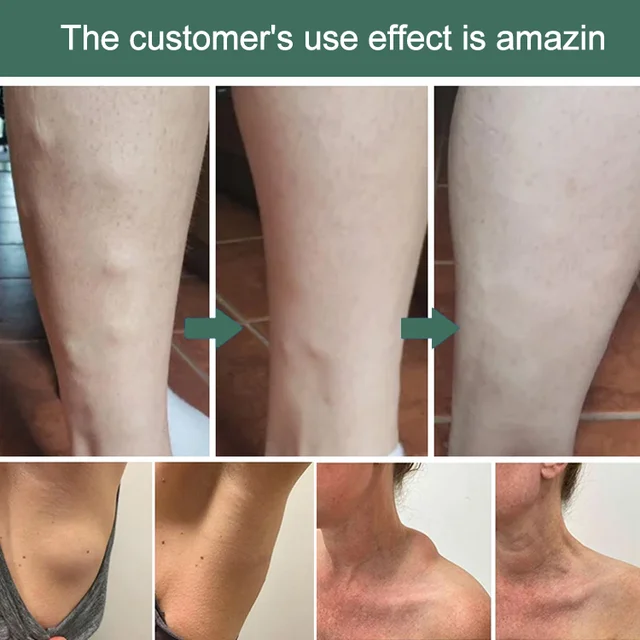 Lipoma Removal Cream