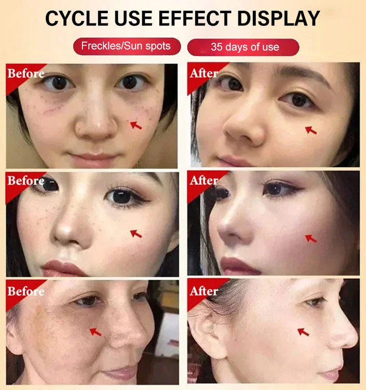 BRIGHTENING FRECKLE CREAM