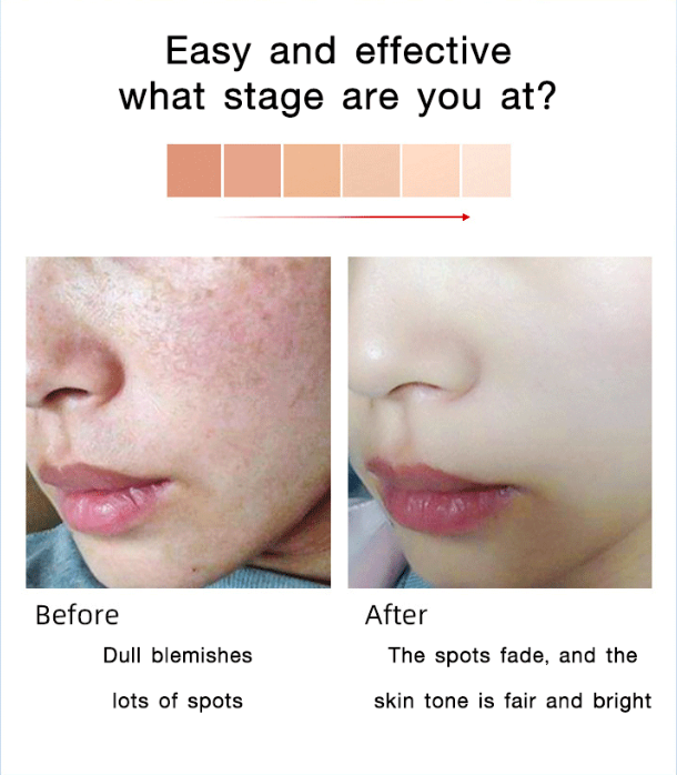 Whitening Anti-Freckle Moisturizing Cream
