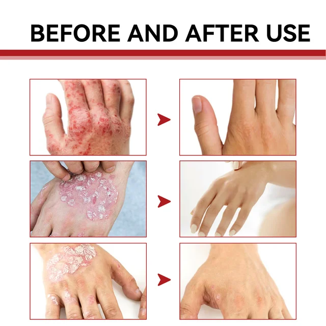 Psoriasis Treatment Cream Moss Repair Itchy Skin Relief