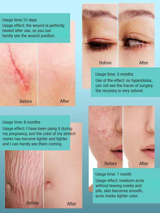Advanced Scar Removal Spray
