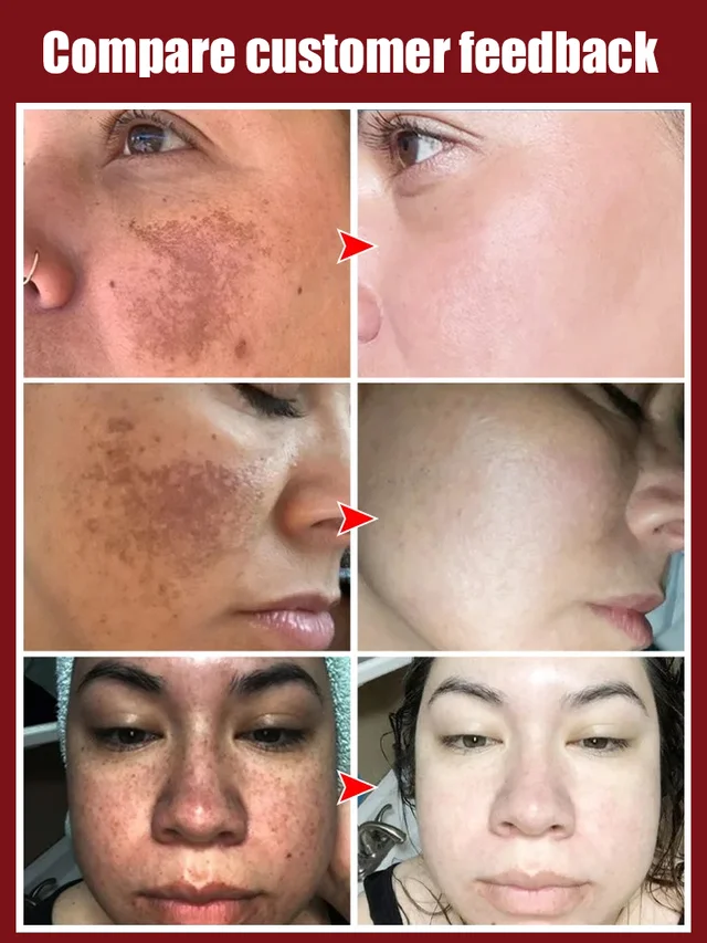 Whitening and spot cream