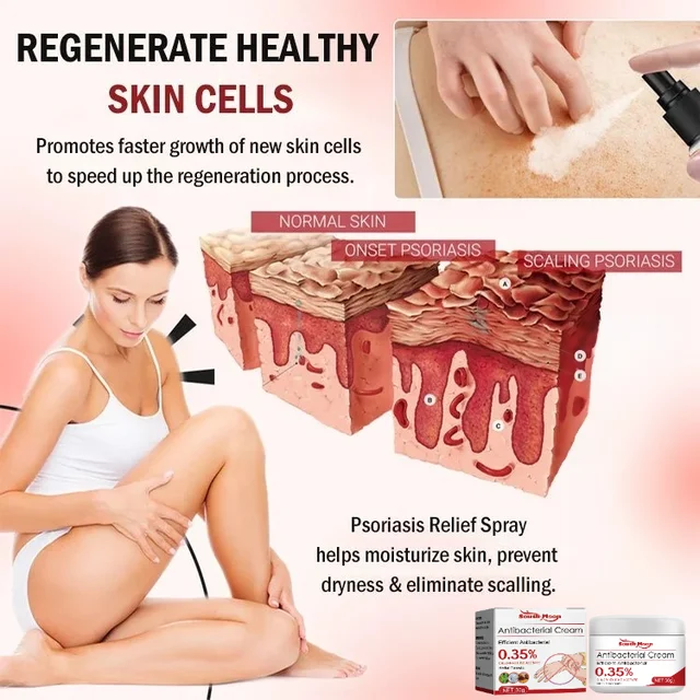 Psoriasis Treatment Cream Moss Repair Itchy Skin Relief