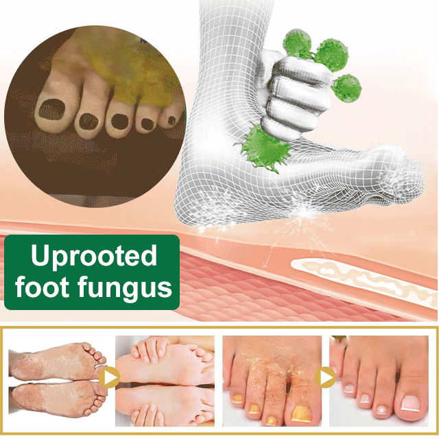Athletes foot treatment herbal antibacterial spray