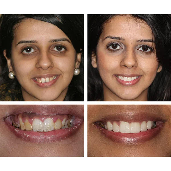 LANTHOME™ Teeth Whitening Essence